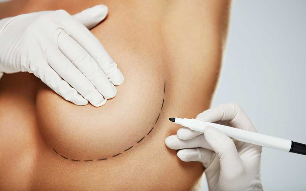 Breast Reduction (Mammoplasty) Treatment in Pascoe Vale, Melbourne